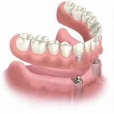 implant-supported-overdenture
